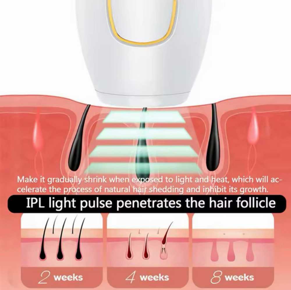 إزالة الشعر بالليزر بتقنية IPL